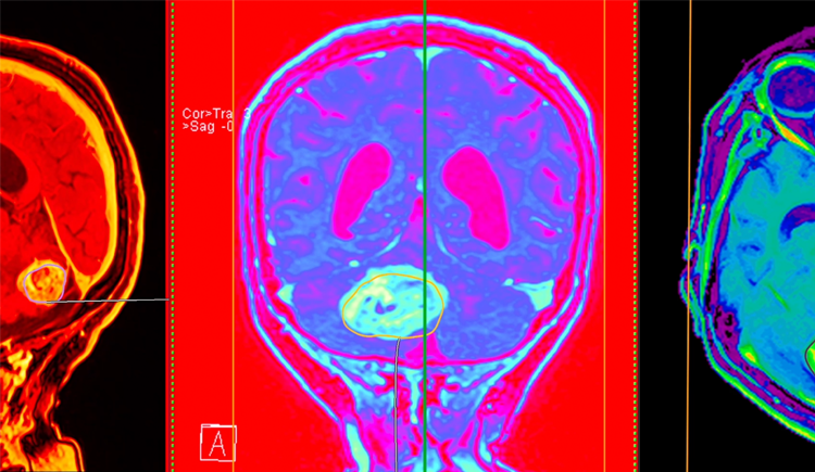 Illustration of the brain tumor tissue analysis study